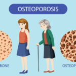 Tips to Prevent Osteoporosis