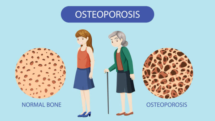 Bone Density and Osteoporosis Vector