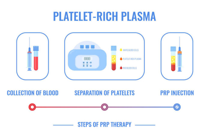 Medical infographics for platelet rich plasma procedure